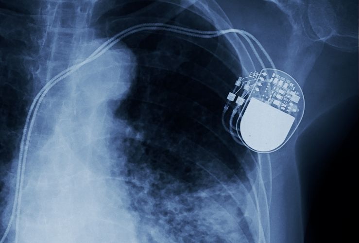Xray showing pacemaker
